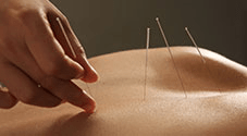 Myofascial dry needling resets tight muscles
